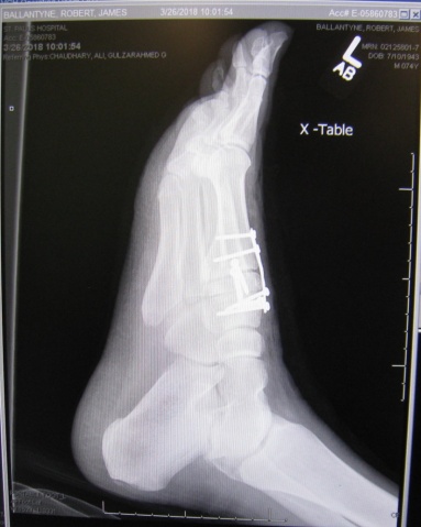 X-ray profile of the left foot with the plate and screws - lisfranc injury