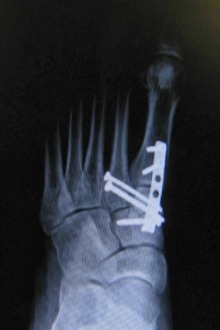 X-ray closeup of the left foot with the plate and screws - lisfranc injury