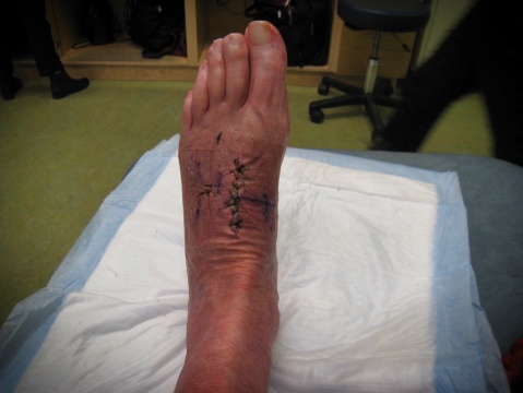 There are two incisions - lisfranc injury. The large one is between the bones of the large toe and the 2nd toe. There is a tiny one between the 3rd and 4th toe.